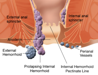 Piles Treatment