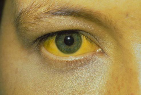 Jaundice Treatment